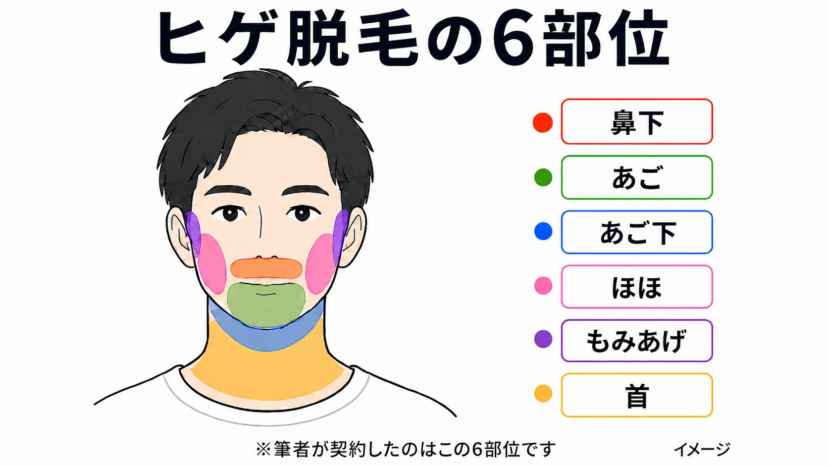 ヒゲ脱毛の6部位(鼻下・あご・あご下・ほほ・もみあげ・首)を色分けした顔の図解イラスト